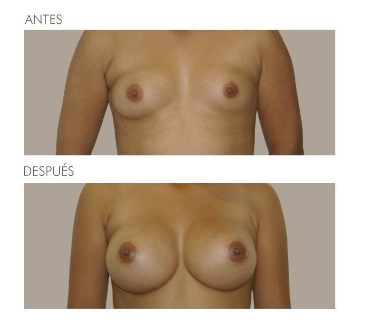 MAMOPLASTIA DE AUMENTO
