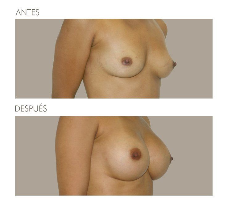 MAMOPLASTIA DE AUMENTO