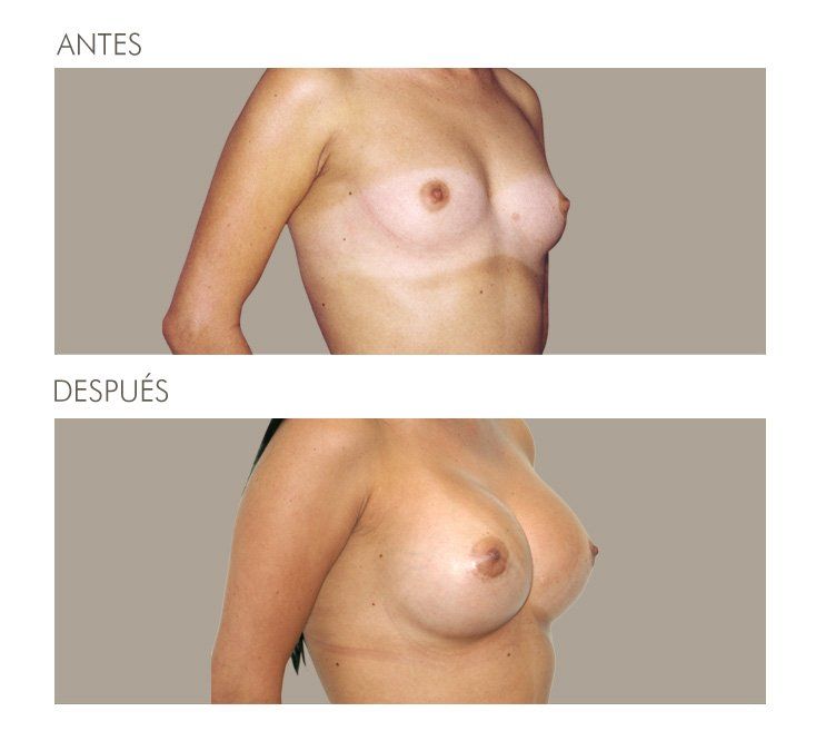 MAMOPLASTIA DE AUMENTO