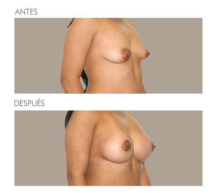 MAMOPLASTIA DE AUMENTO