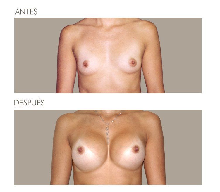 MAMOPLASTIA DE AUMENTO