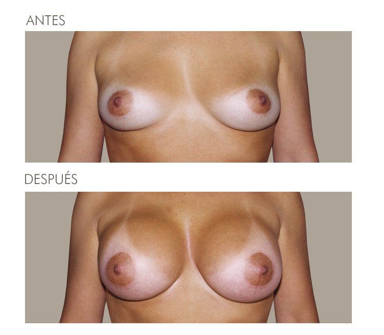 MAMOPLASTIA DE AUMENTO