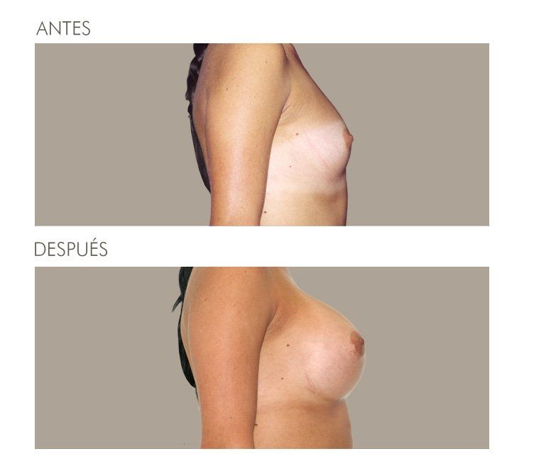 MAMOPLASTIA DE AUMENTO