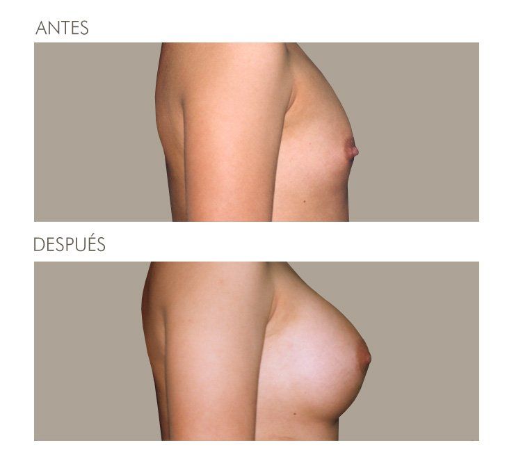 MAMOPLASTIA DE AUMENTO