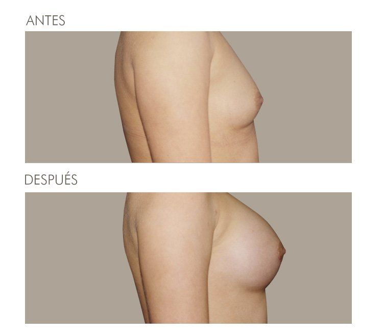 MAMOPLASTIA DE AUMENTO