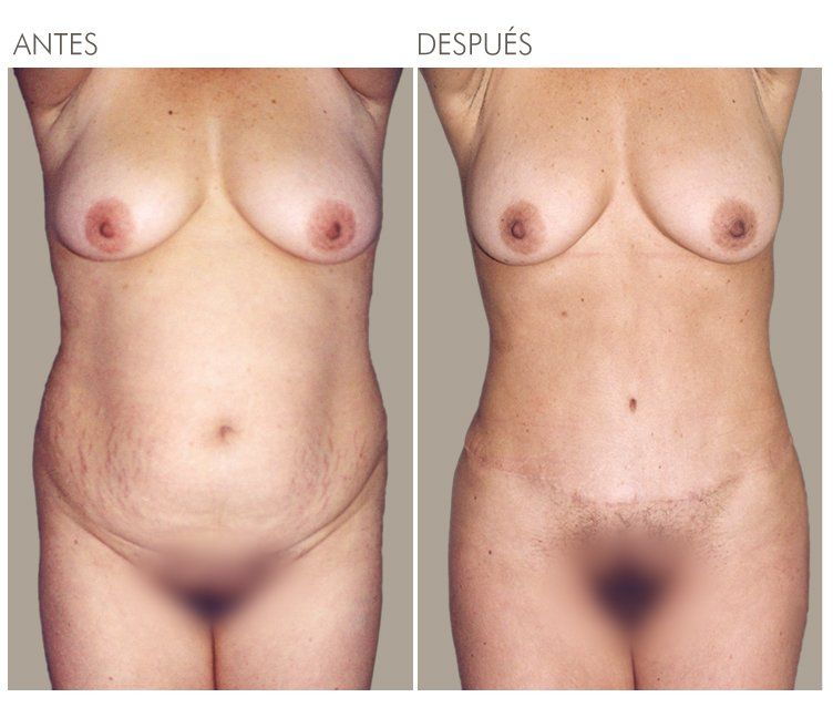 ABDOMINOPLASTIA