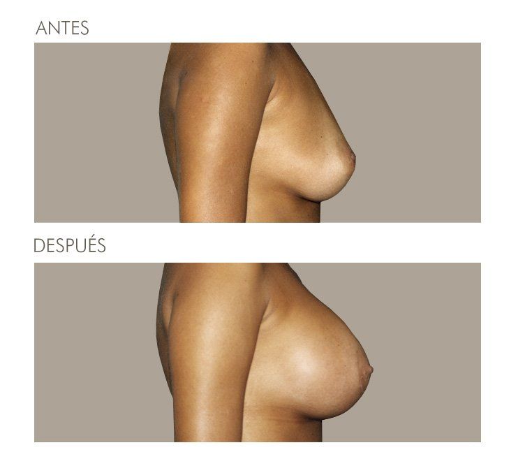 MAMOPLASTIA DE AUMENTO
