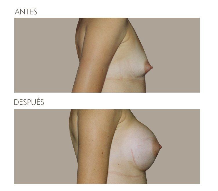 MAMOPLASTIA DE AUMENTO