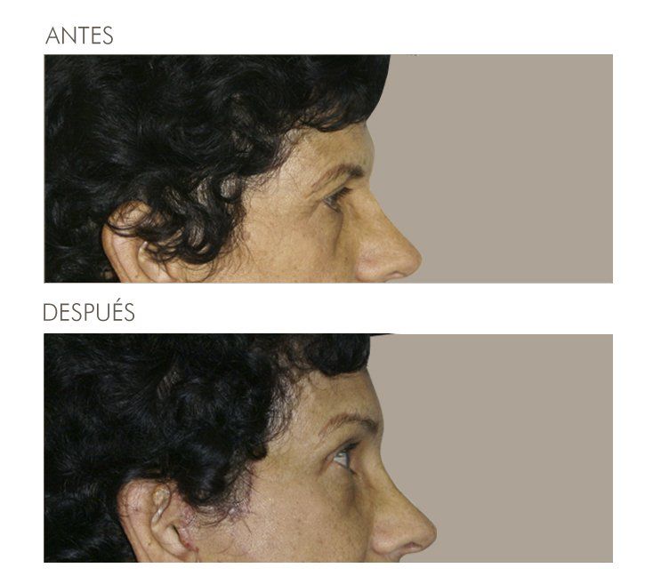 A before and after photo of a woman 's face