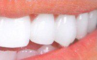 after teeth whitening