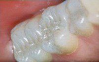 after tooth-colored fillings