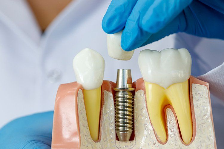 A dentist is holding a model of teeth with a dental implant in it.