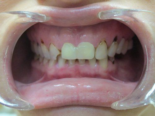 before multiple mouth restorations