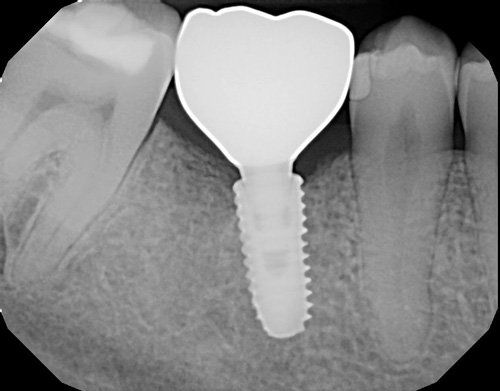 x-ray - after implant and crown