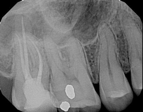 x-ray - after root canal therapy