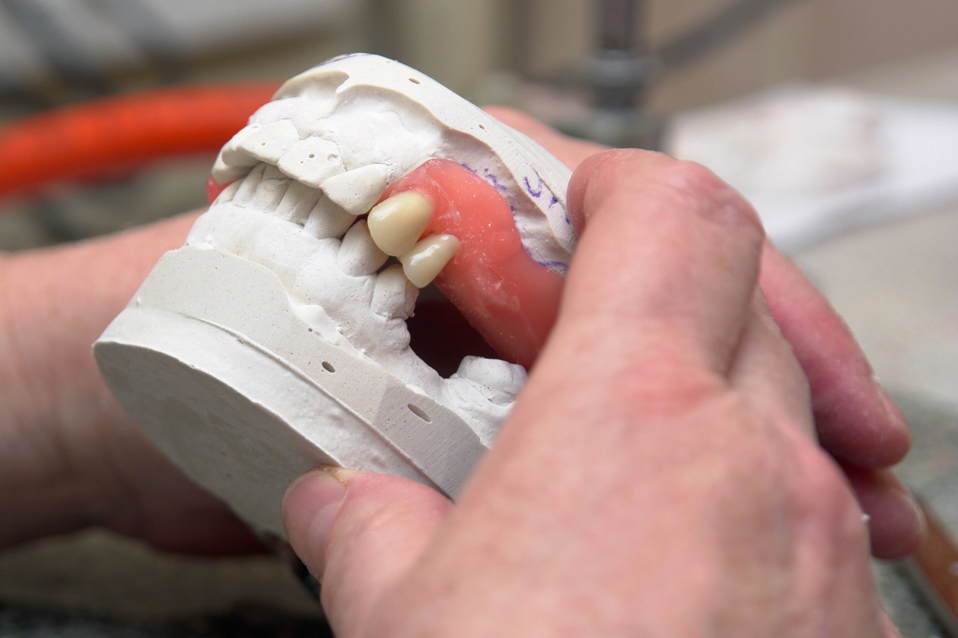 Mani che reggono un modello in gesso di un'apparecchio dentale con una protesi parziale dotata di due denti artificiali.