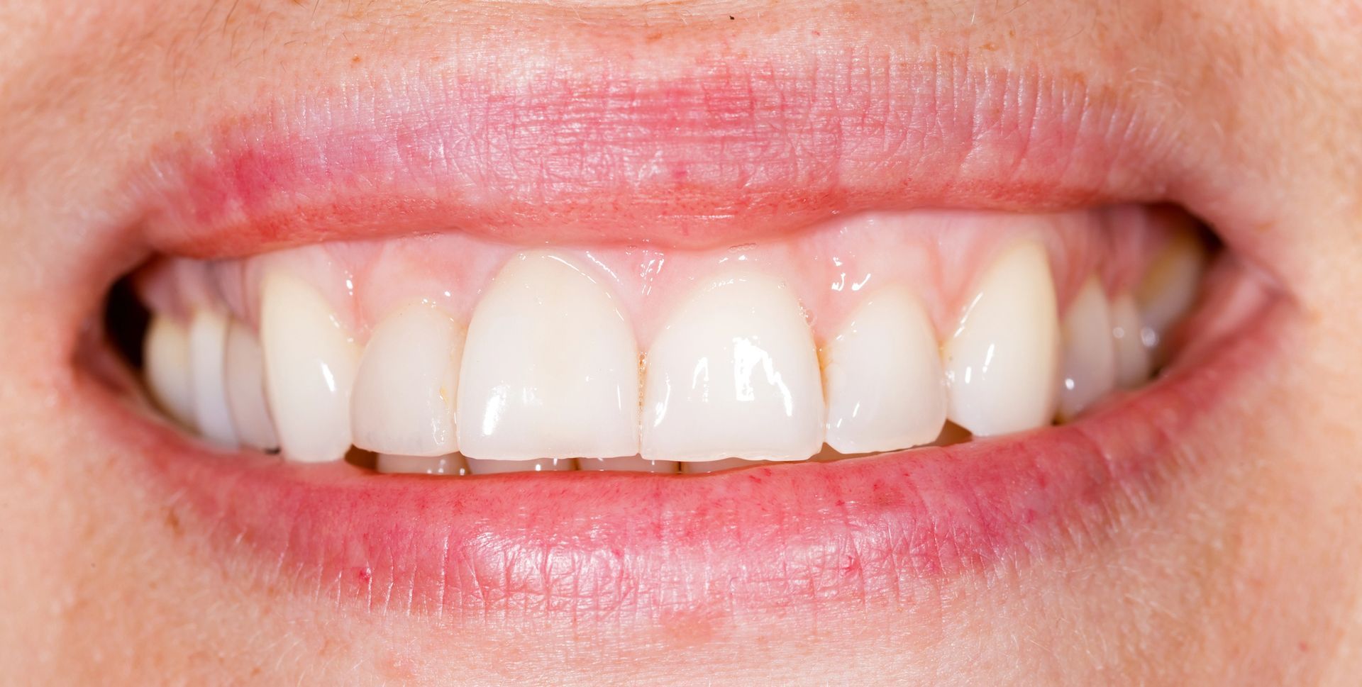 Primo piano della bocca di una persona in un sorriso delicato ed neutro, che mostra denti puliti e allineati e gengive sane e rosa.