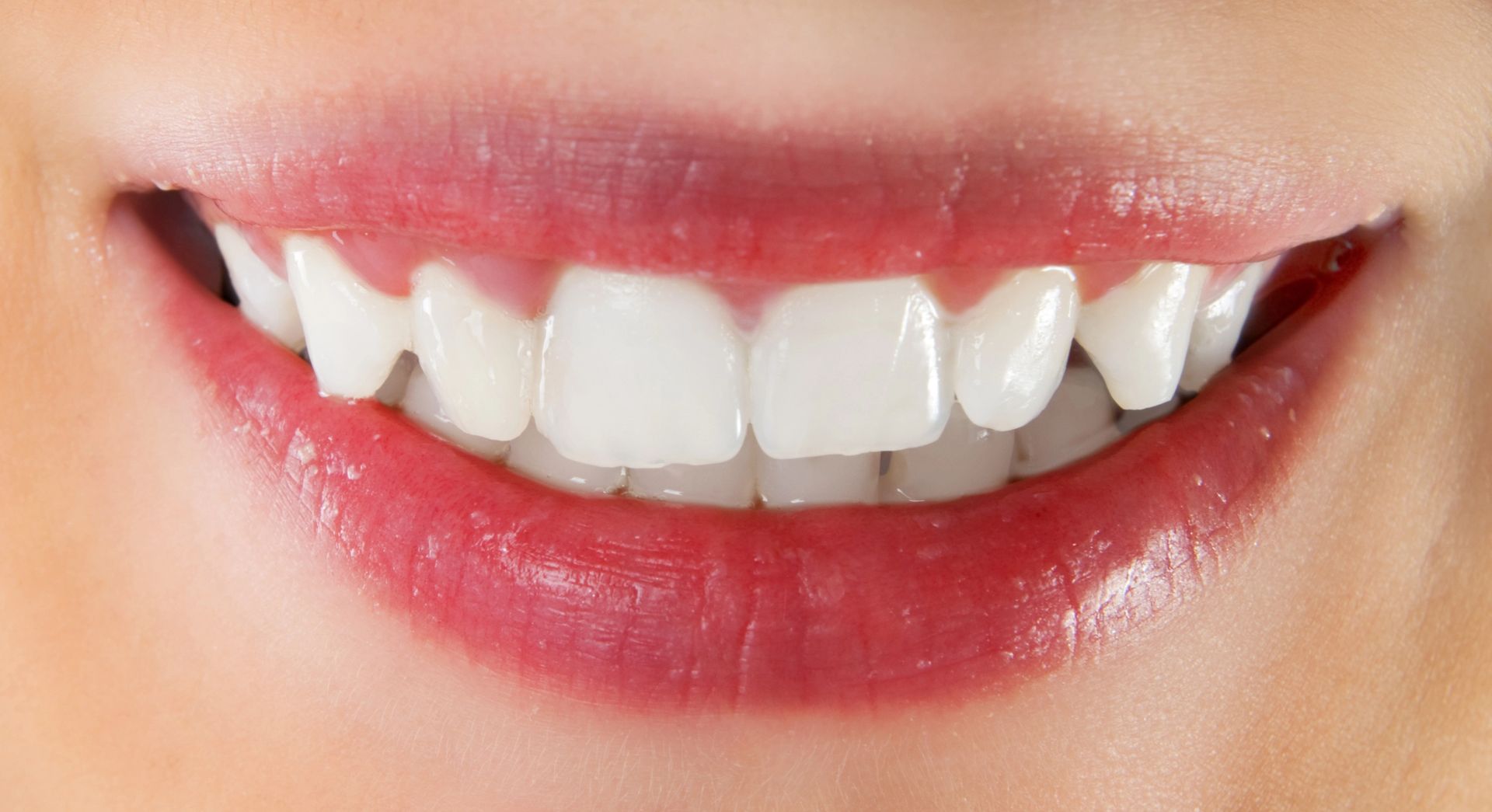 Un primo piano di una bocca sorridente che mostra denti e labbra puliti e bianchi.