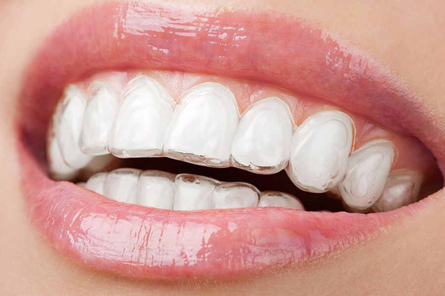 Primo piano della bocca di una persona che indossa allineatori trasparenti sui denti superiori e inferiori.