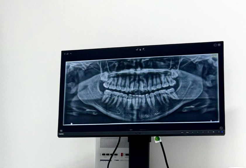 Un monitor di computer visualizza una radiografia dentale panoramica che mostra denti e struttura mascellare su uno sfondo bianco uniforme.