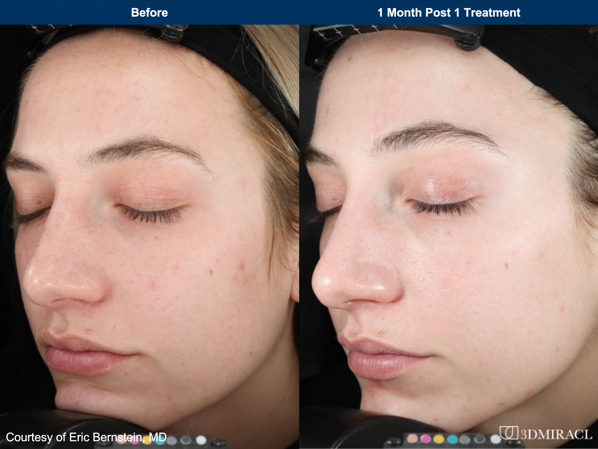 A before and after photo of a woman 's face during ultra clear laser procedure