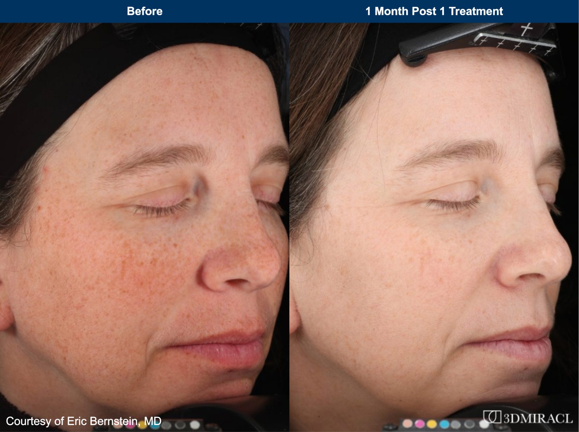 Patient Before and After Botox Cosmetic Treatment. at rest and at expression before, 7 days after, and 14 days after treatment