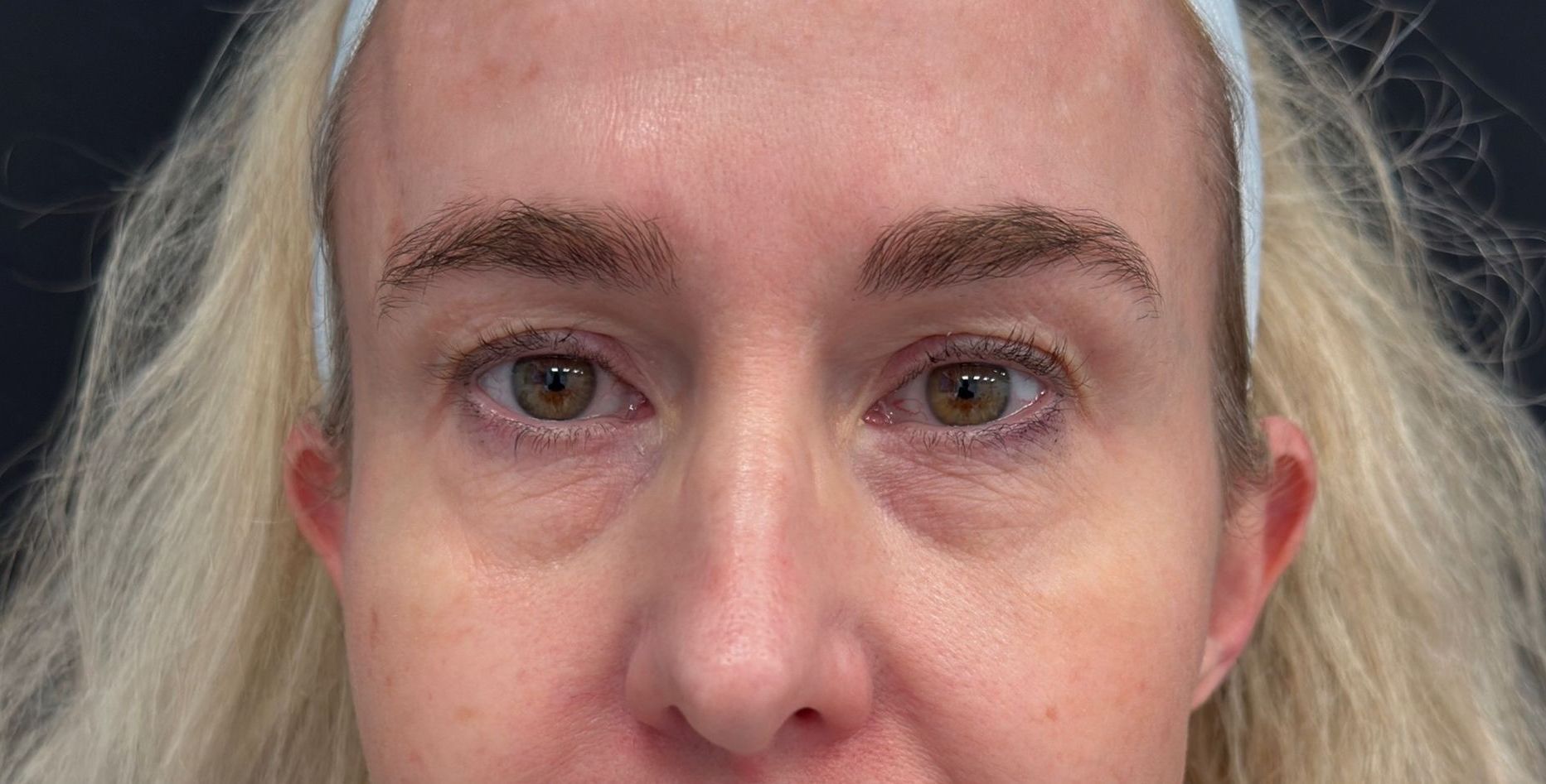 A close up of a woman 's eyes with a nose ring after blepharoplasty surgery