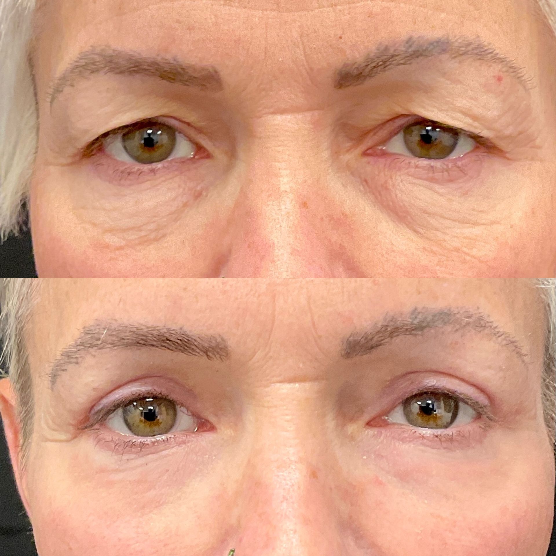 Patient Before and After Upper Blepharoplasty at Clearview Dermatology, Dr. Joe Overman