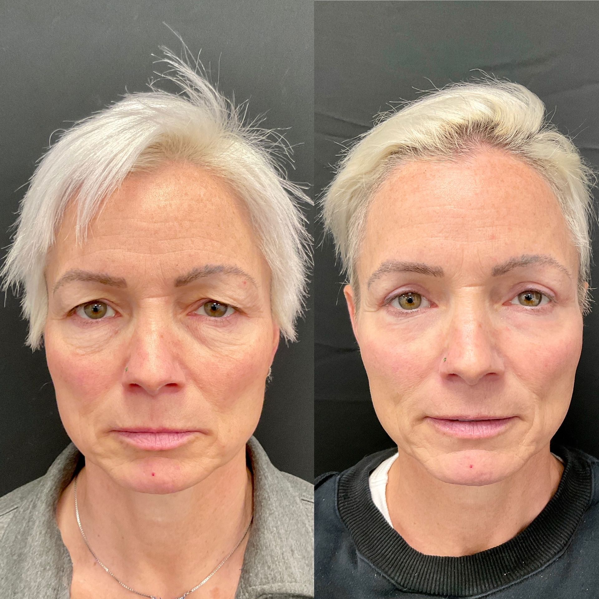 Patient Before and After Upper Blepharoplasty at Clearview Dermatology, Dr. Joe Overman