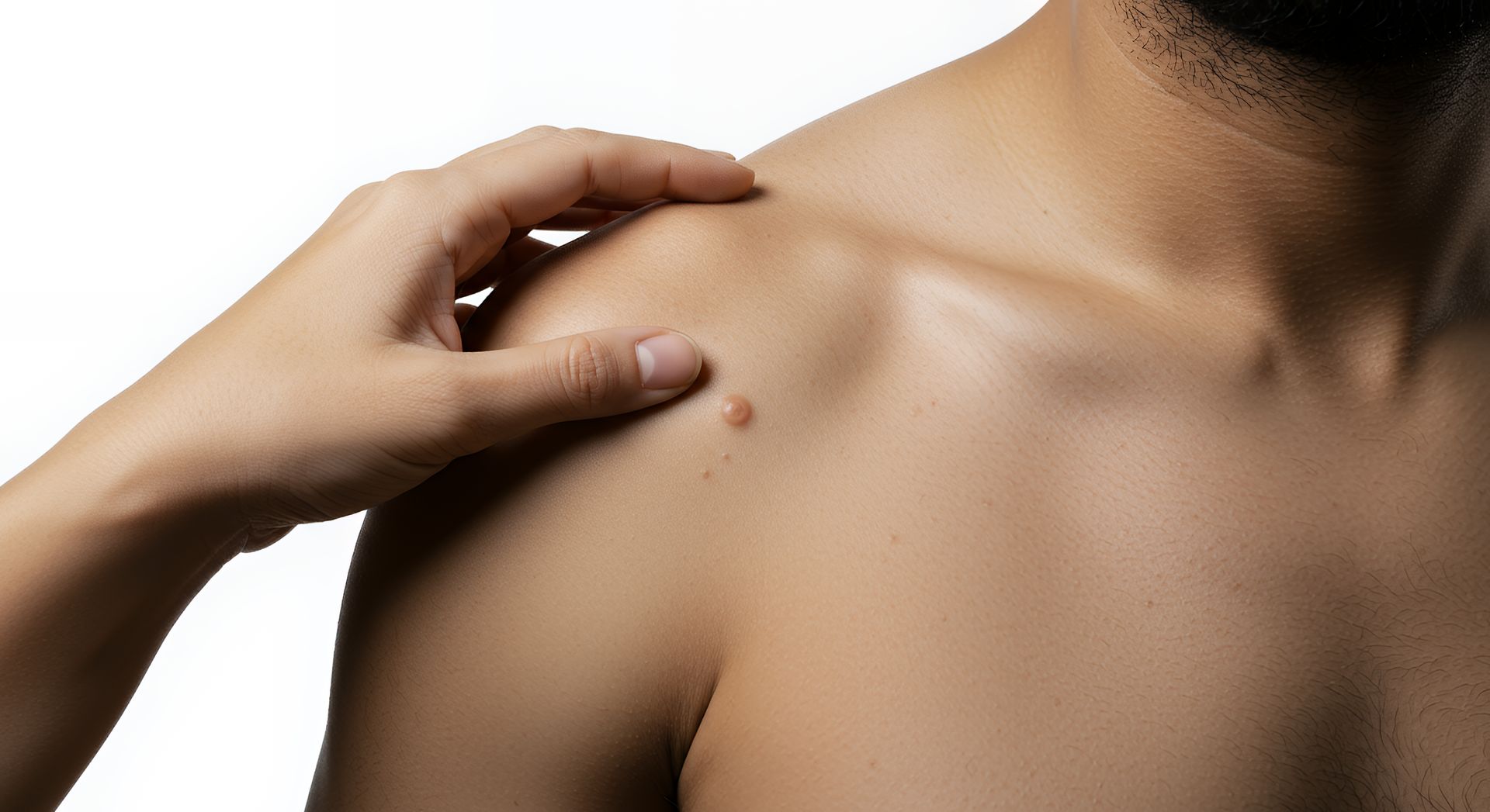 Cancer spot on Shoulder