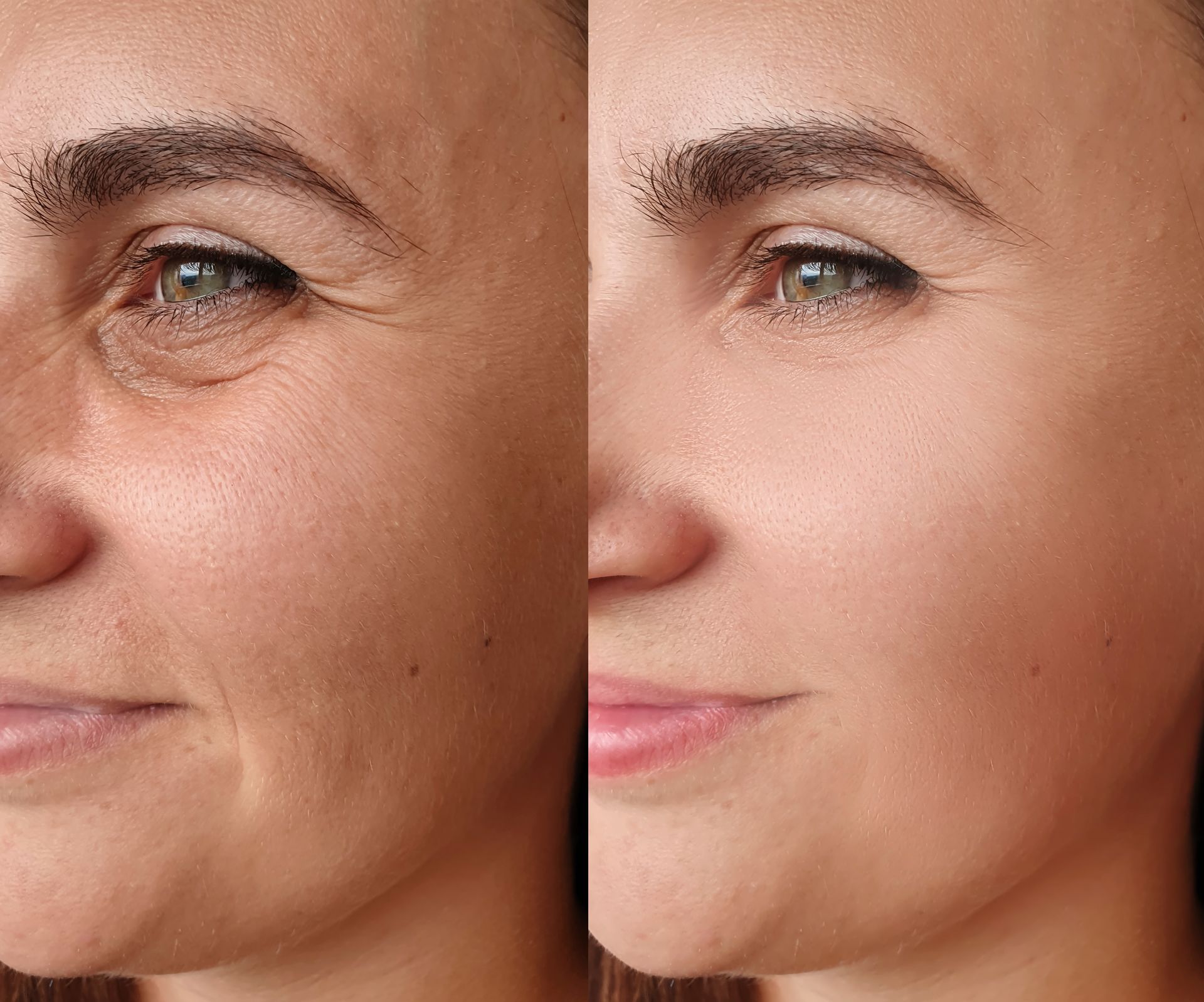 Side-by-side comparison showing a person’s face before and after skin smoothing, demonstrating reduced fine lines.