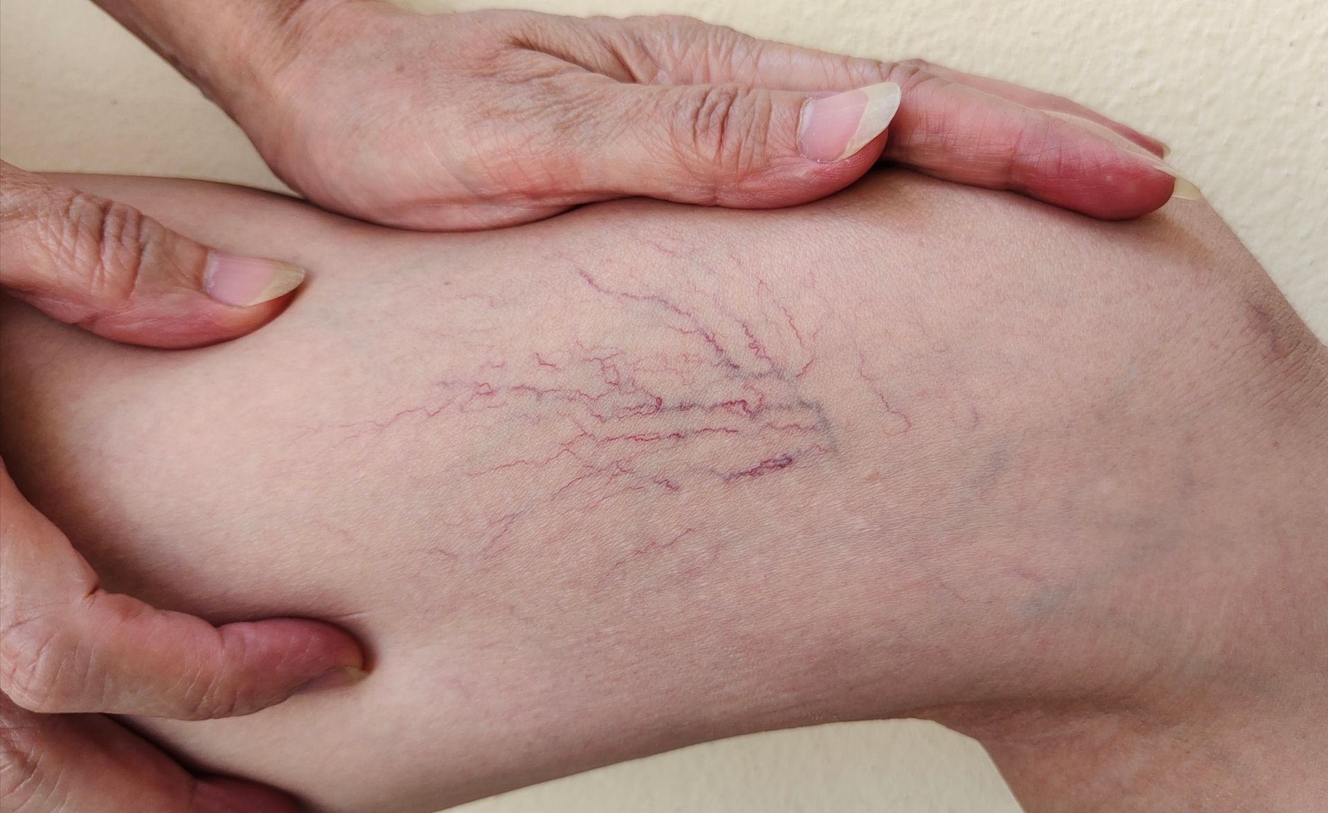 Scars on thigh