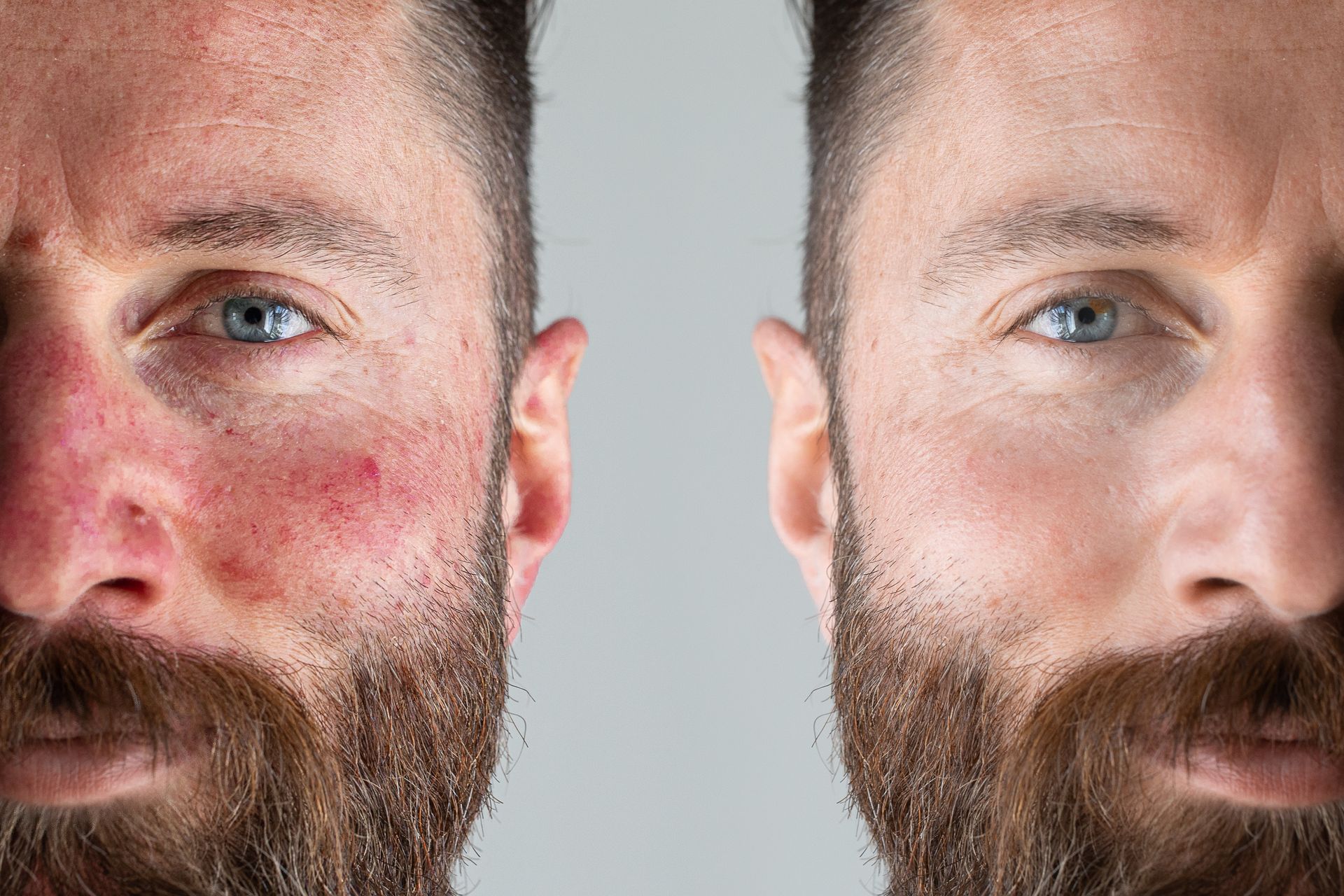 Two faces: one with red spots, one clear.