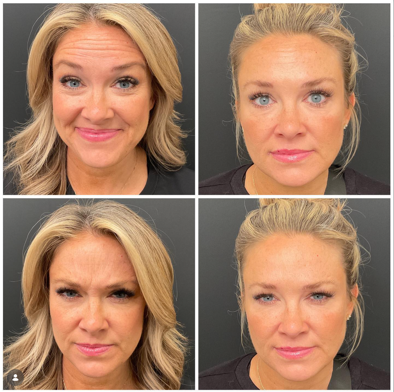 patient at clearview dermatology before and after botox cosmetic