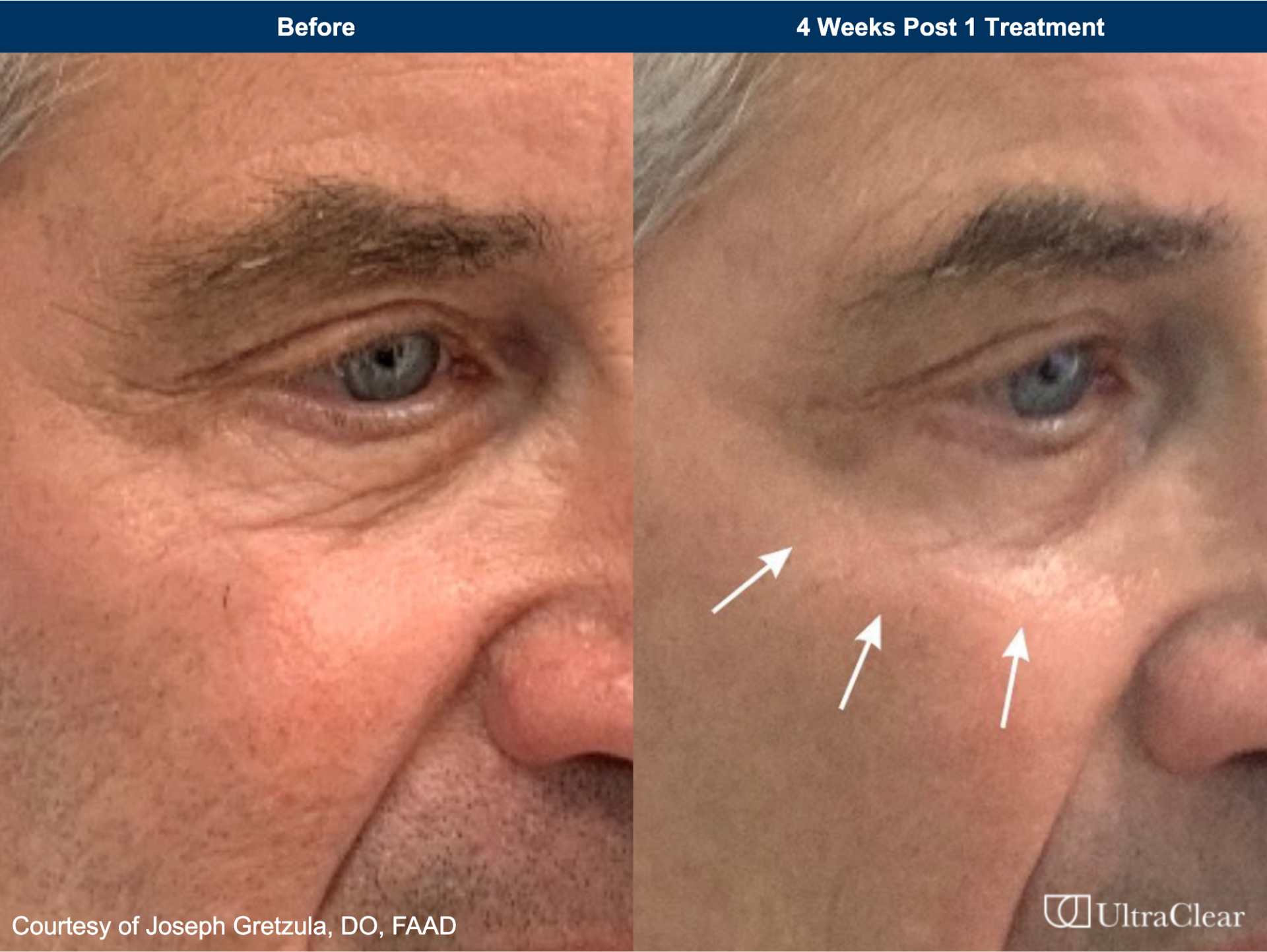 Patient Before and After Botox Cosmetic Treatment. at rest and at expression before, 7 days after, and 14 days after treatment