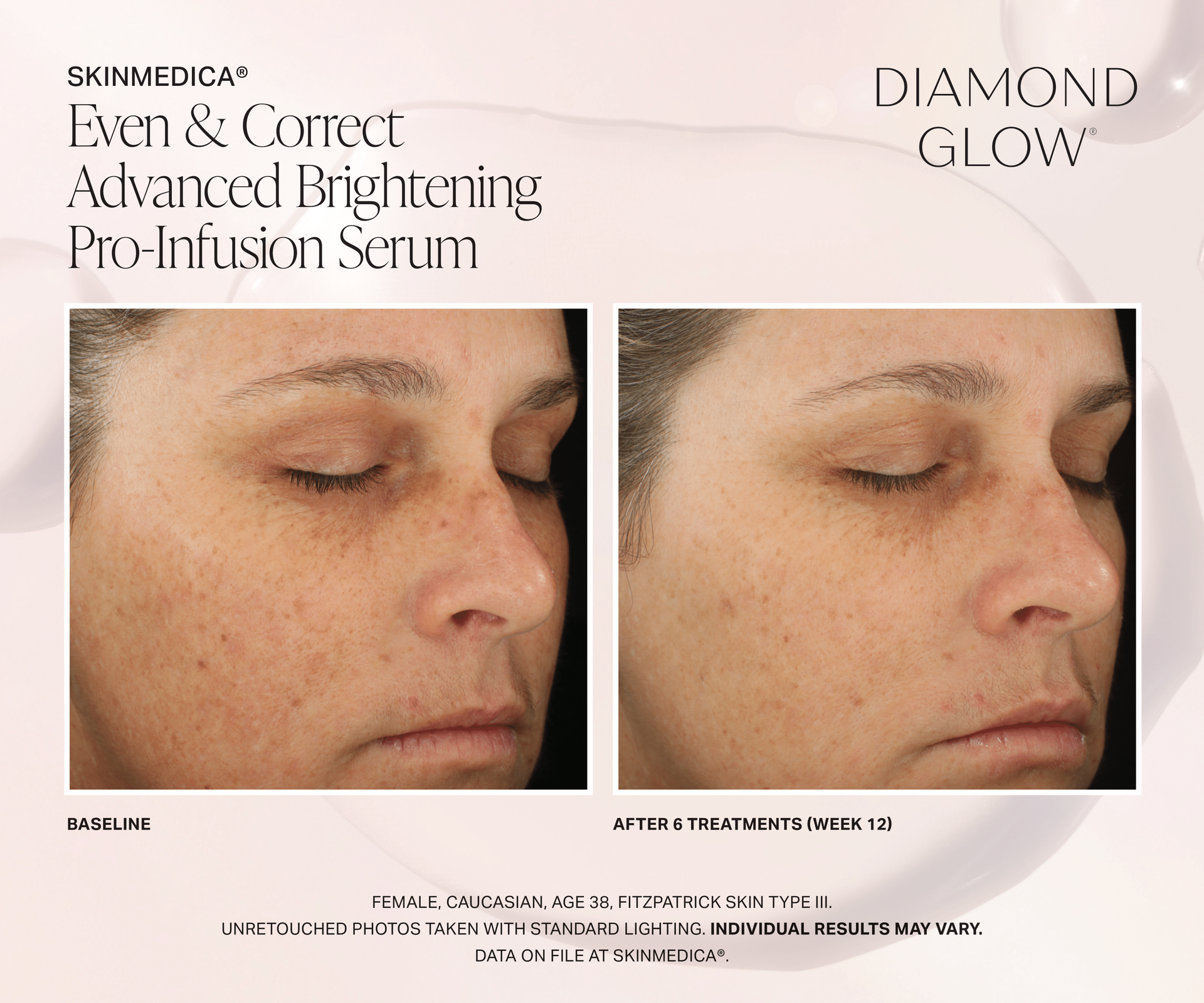 Patient Before and After DiamondGlow Even and Correct Advanced Brightening Pro-Infusion Treatment. After 6 Treatments (Week 12) On female caucasian age 38