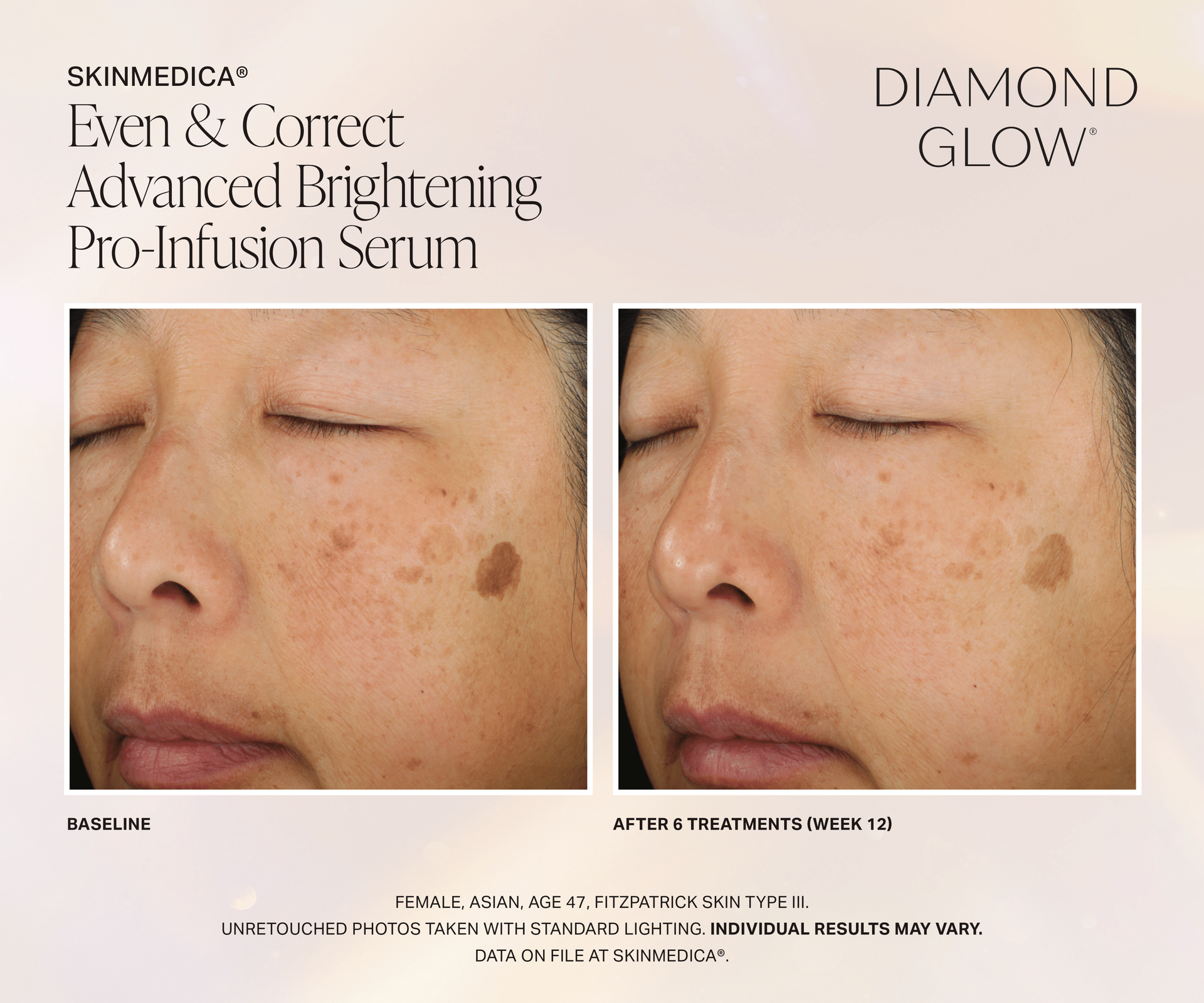 Patient Before and After DiamondGlow Even and Correct Advanced Brightening Pro-Infusion Treatment. After 6 Treatments (Week 12) On female asian age 47