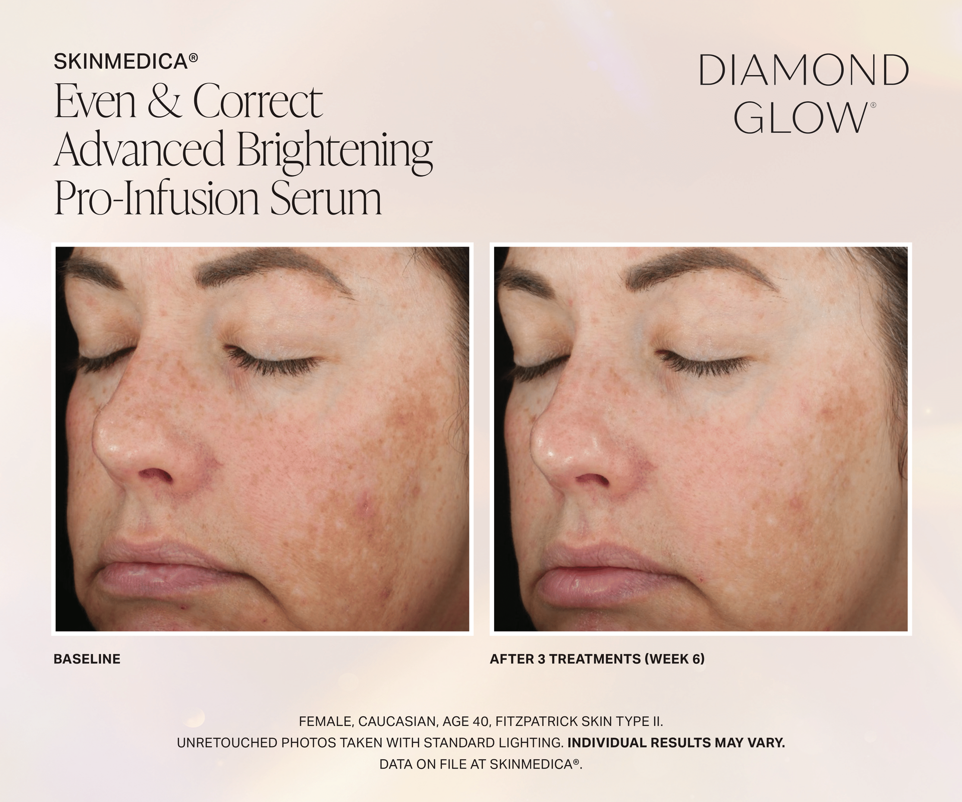 Patient Before and After DiamondGlow Even and Correct Advanced Brightening Pro-Infusion Treatment. After 3 Treatments (Week 6) On female caucasian age 40
