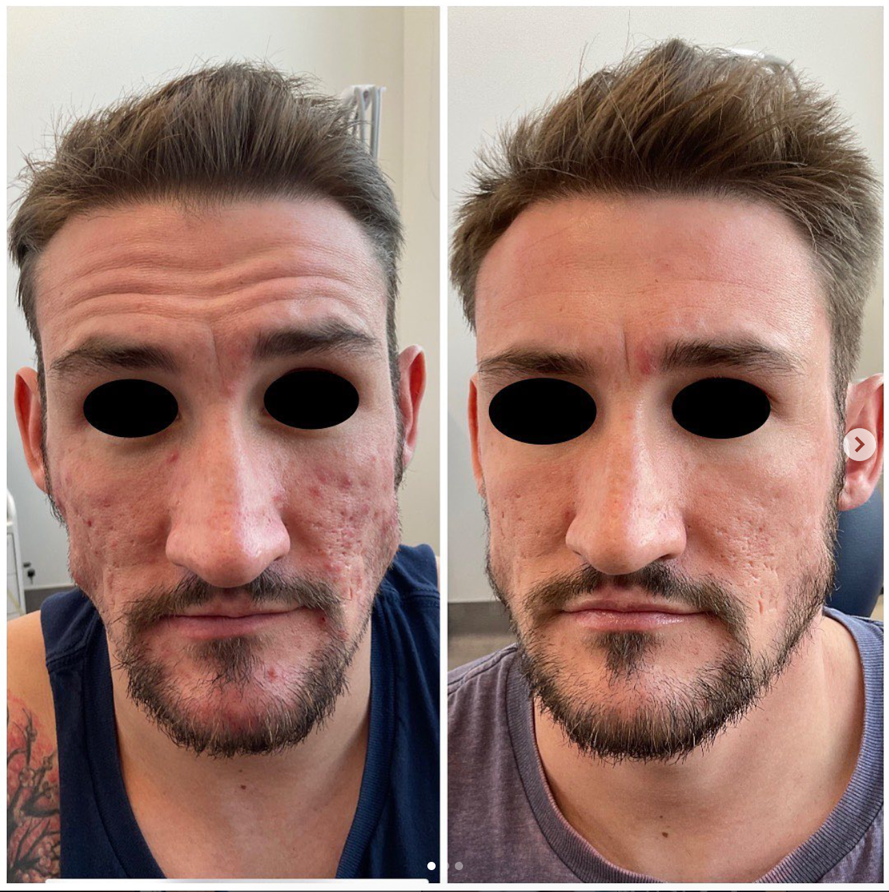 patient at clearview dermatology before and after DiamondGlow for Acne Treatment