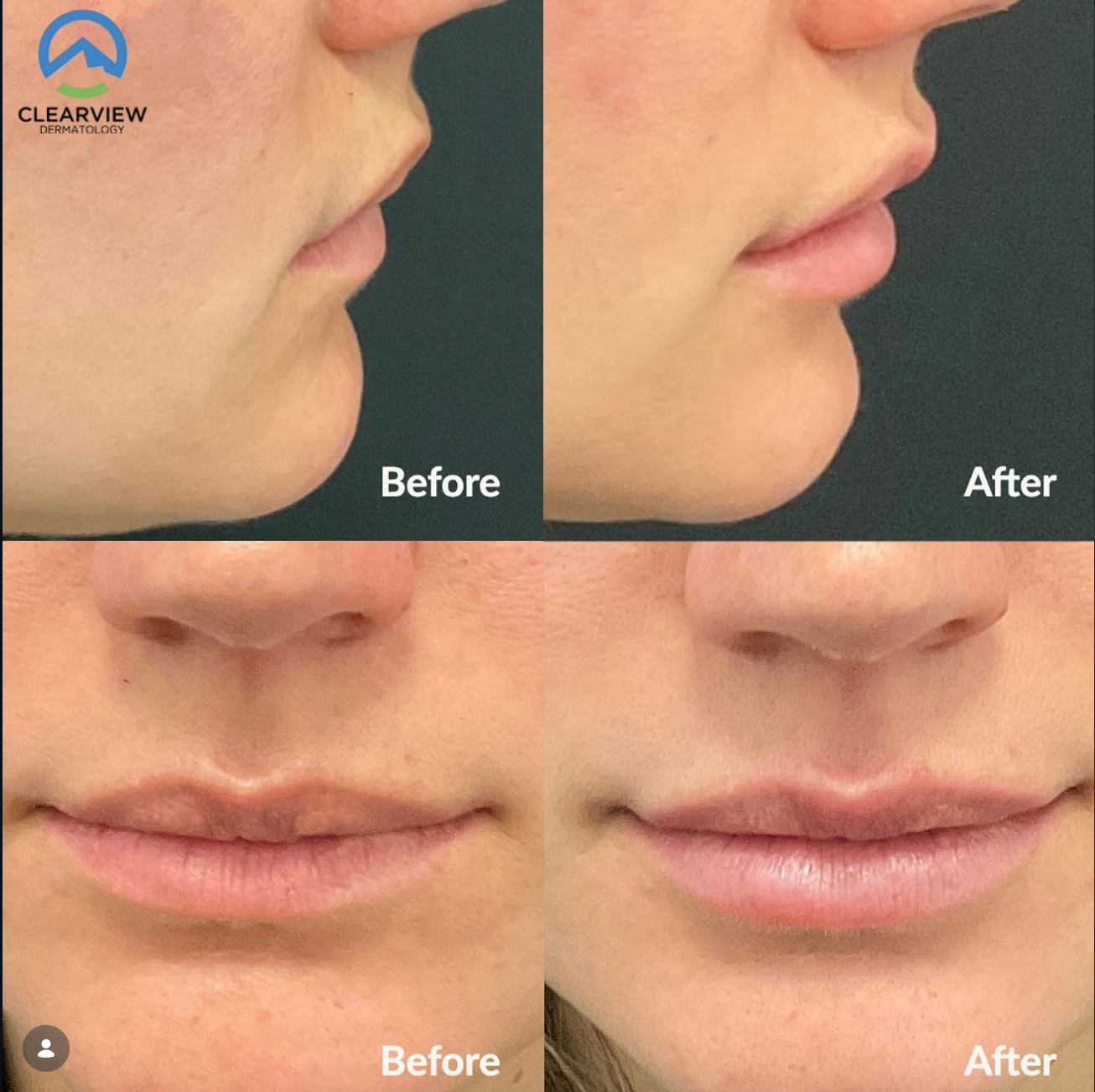 patient at clearview dermatology before and after lip filler