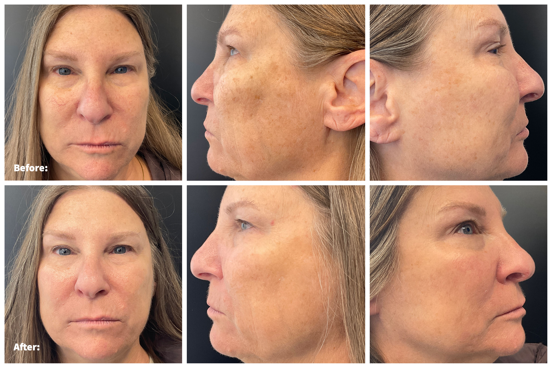 Patient Before and After Excel V+ Laser Treatment on the face at Clearview Dermatology in Arvada CO