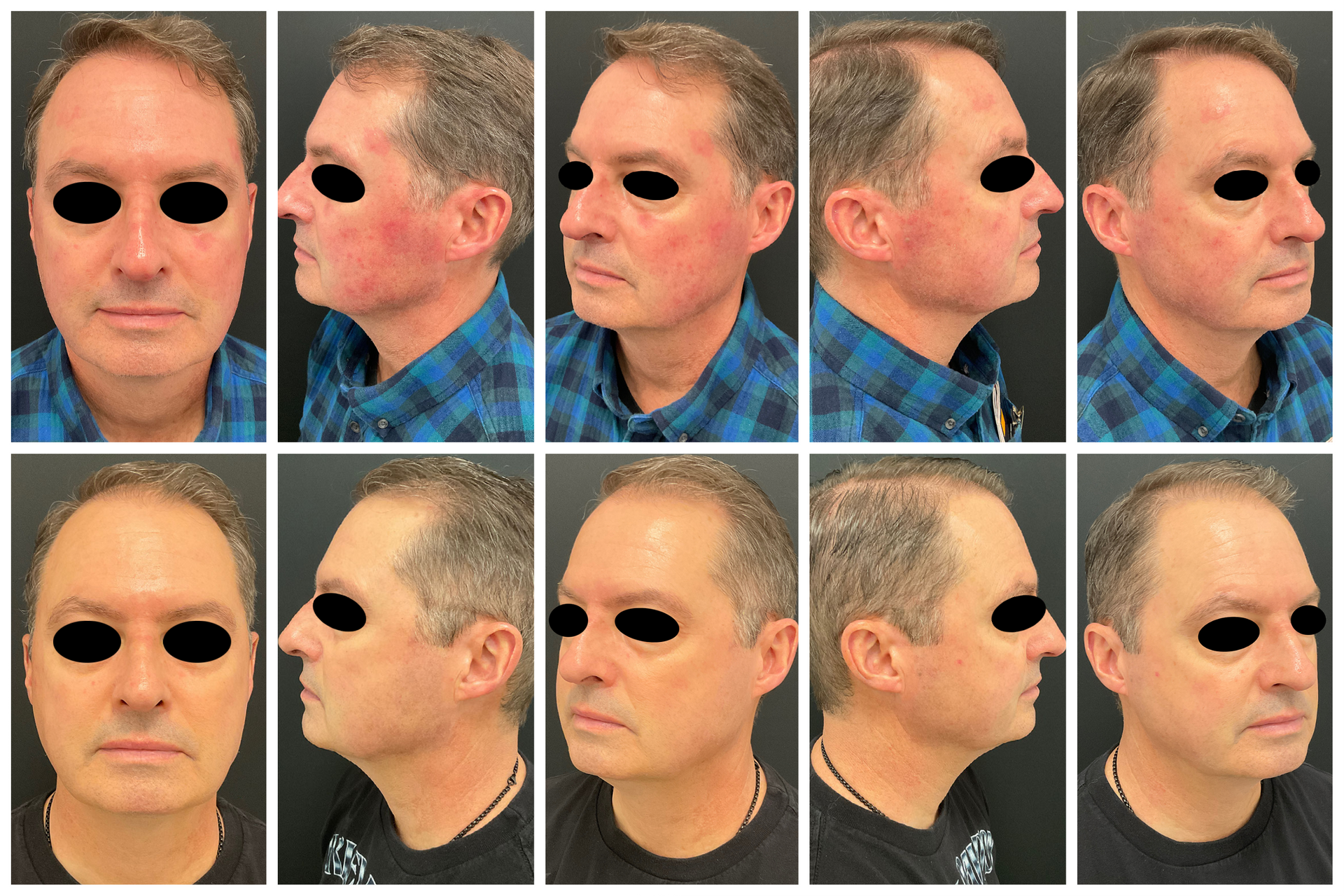 Patient Before and After Excel V+ Laser Treatment on the face at Clearview Dermatology in Arvada CO