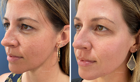 patient at clearview dermatology in arvada colorado before and after fraxel laser treatment