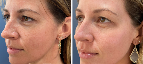 patient at clearview dermatology in arvada colorado before and after co2 laser treatment