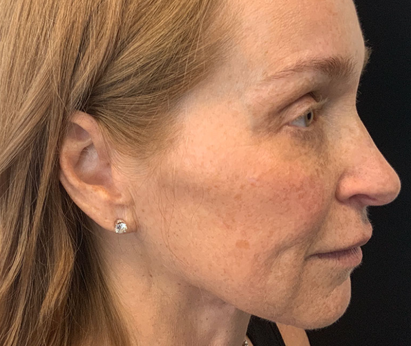 patient at clearview dermatology in arvada colorado before and after fraxel laser treatment
