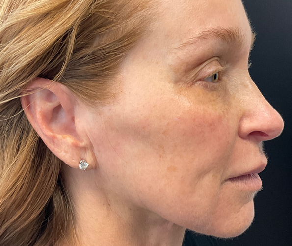 patient at clearview dermatology in arvada colorado before and after co2 laser treatment