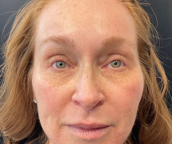 patient at clearview dermatology in arvada colorado before and after co2 laser treatment