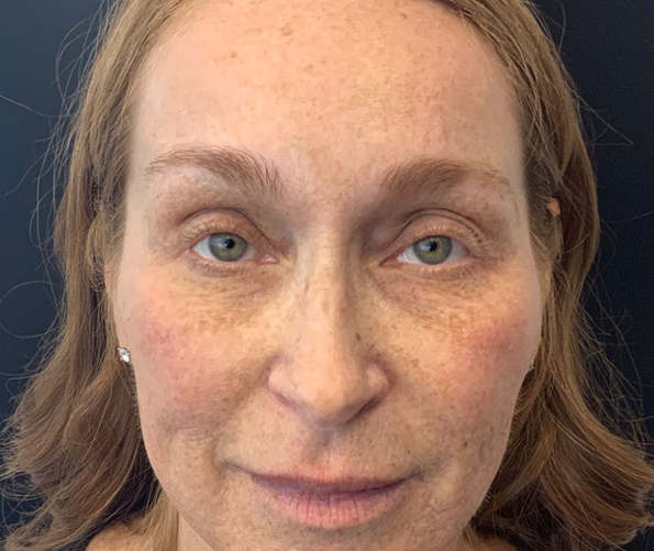 patient at clearview dermatology in arvada colorado before and after fraxel laser treatment