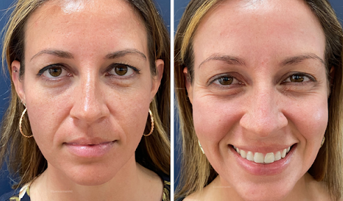 patient at clearview dermatology in arvada colorado before and after fraxel laser treatment