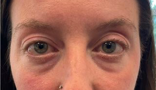 A close up of a woman 's eyes with a nose ring after blepharoplasty surgery
